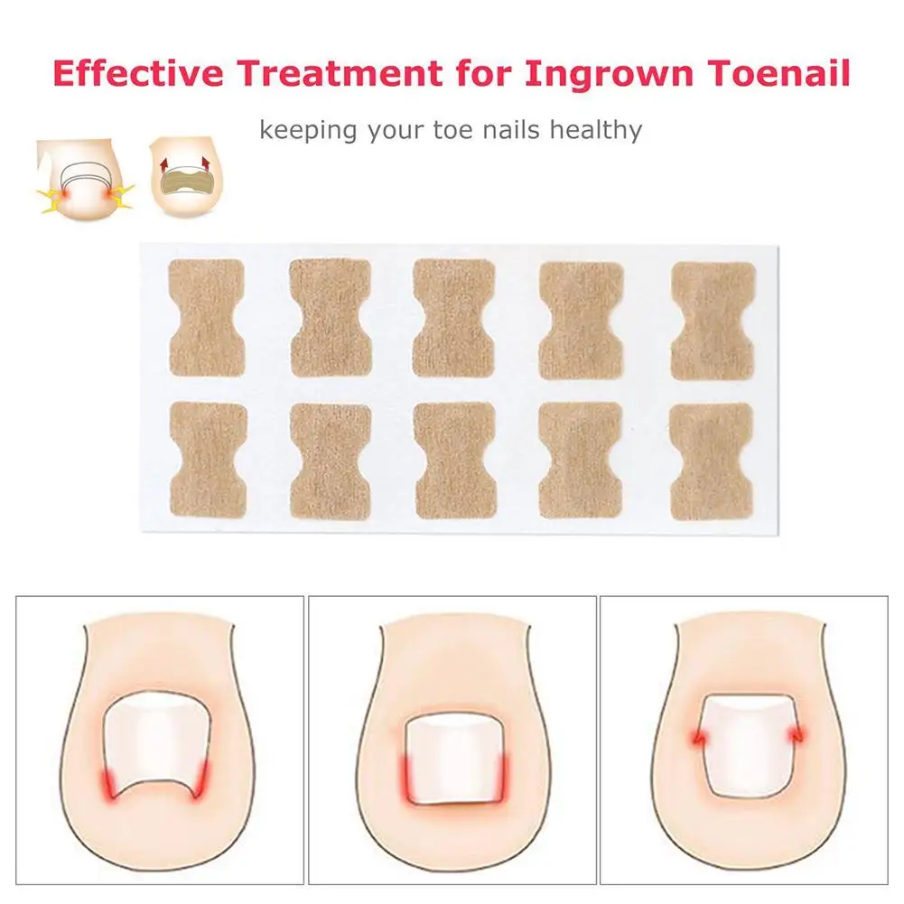 Корректор для вросших ногтей O2O2 1 3*1 8 см корректор лечение паронихии инструменты