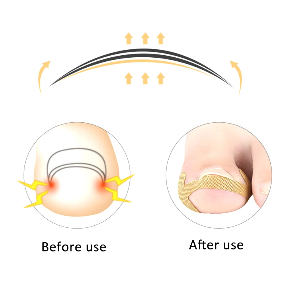 

Ingrown Toenail Tools Correction Patches Lifter File Removal Professional Pedicure Nails Healthy Paronychia Treatment Recover