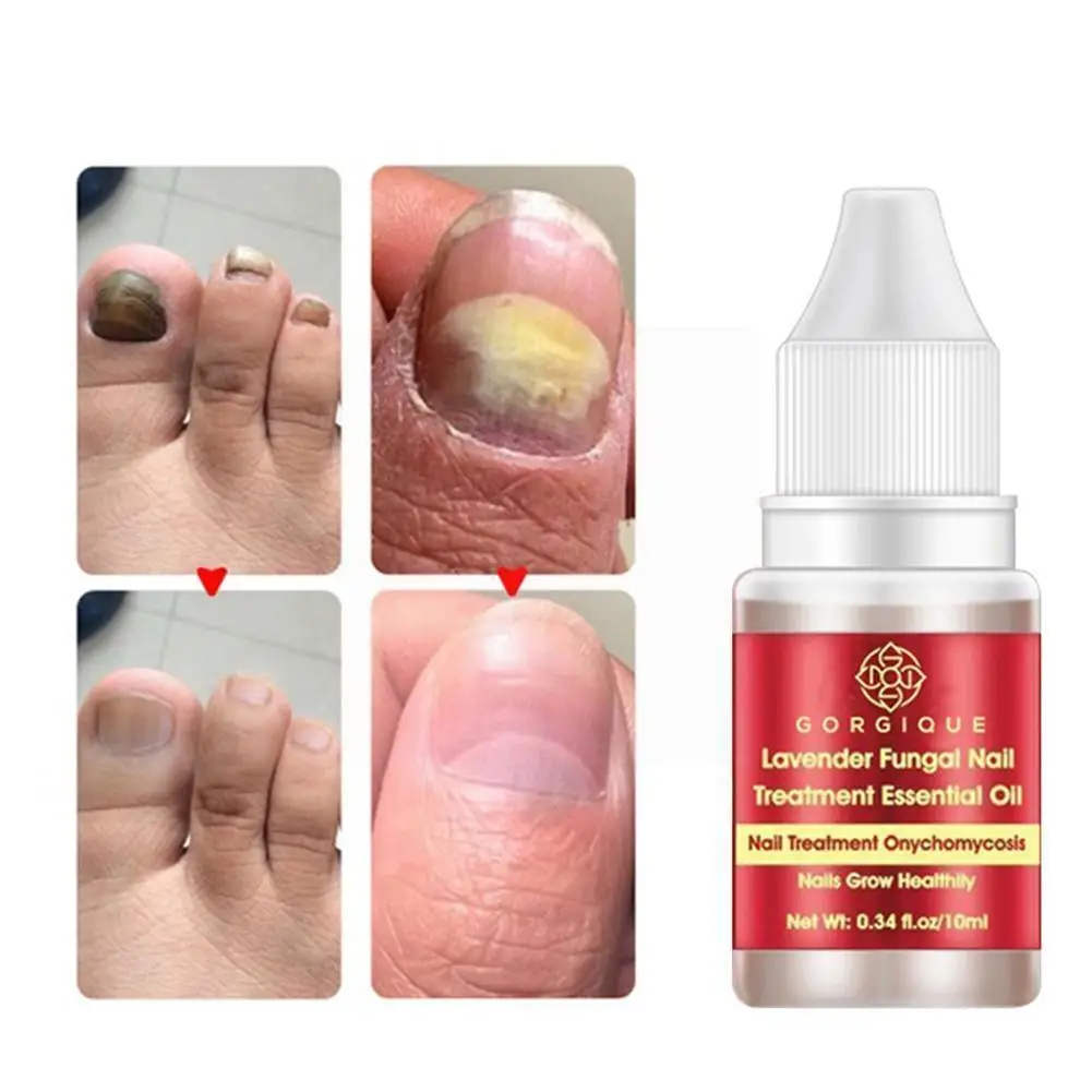 

Lavender Nourishing Nail Essential Oil Fungus Nail Repair And Foot Care Anti Onychomycosis Removal U2K4