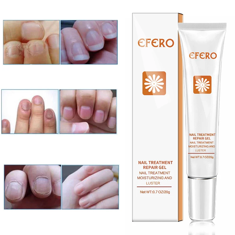 

15-5Pcs Nail Care Anti-fungal Nail Treatment Pen Removal Gel Anti Infection Onychomycosis Paronychia Anti Fungal Nail Repair