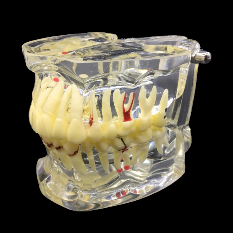 Стоматологическая прозрачная взрослая патологическая Модель дисплея зубов