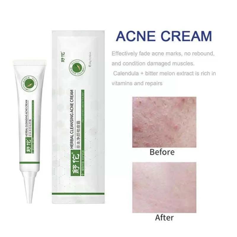 Угревой сыпи травяной крем для чистки ремонт акне косточки пор против уход
