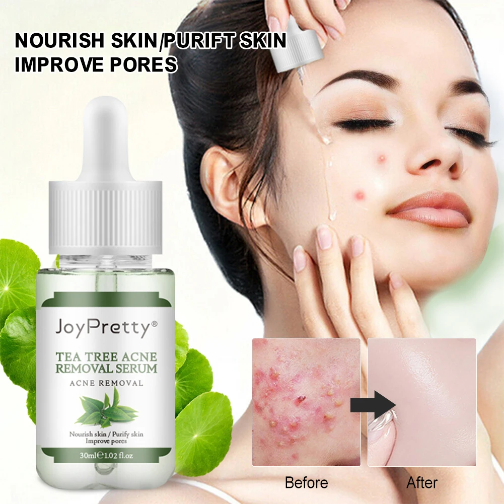 

Tea Tree Acne Treatment Nourish Face Serum Reduce Acne Scars Essence Oil Control Moisturizer Brighten Shrink Pores Beauty Liquid