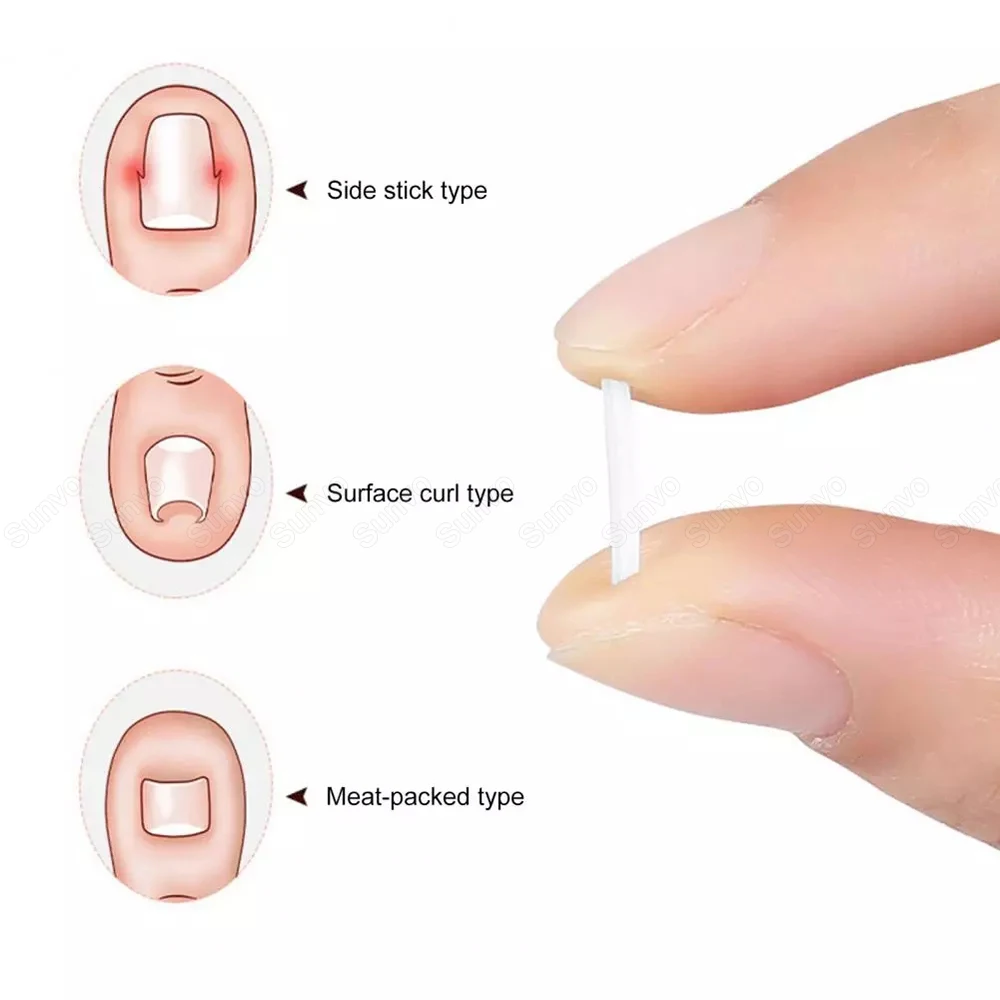 10 шт./компл. корректор для вросших ногтей наполнитель наклейка выпрямления