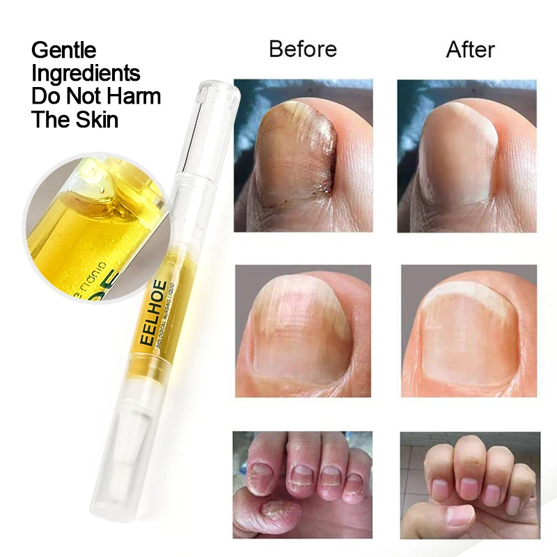1/2 шт. антигрибковая жидкость для ногтей | Красота и здоровье
