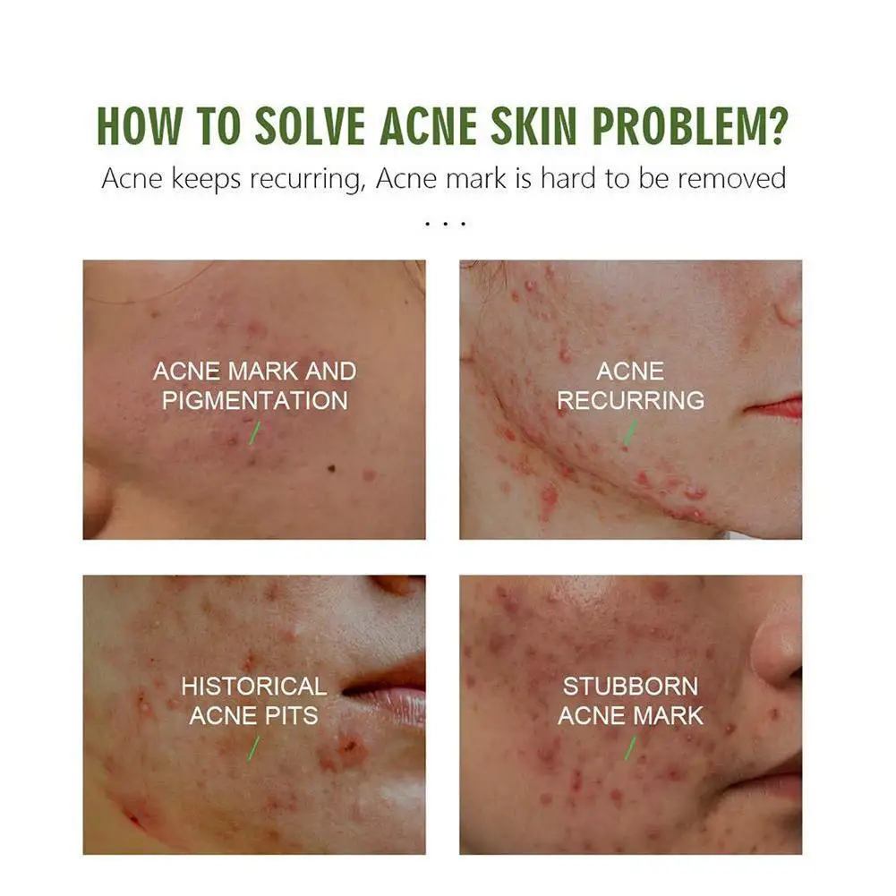 

30g Herbal Acne Cream Light Acne Mark Acne Acne Pits Moisturizing Muscle Acne Oil Acne Cream Control J6Y9