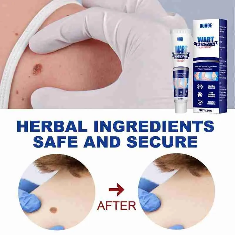 

Skin Tag Remover Ointment Wart Moles Fast Remove Foot Corn Removal Wart Remove Smoothing Whitening Moisturizing Body Skin Care