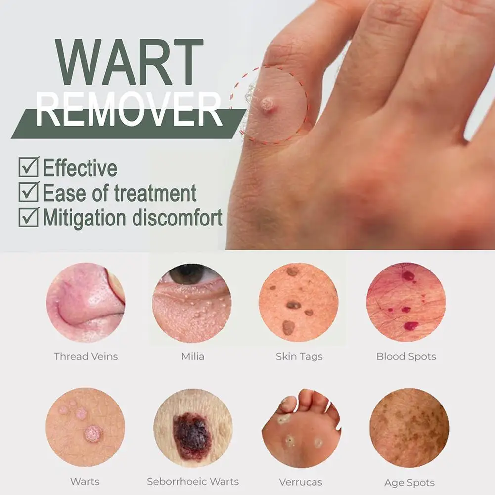 

15ml Skin Tag Remover Against Moles Fast Removal Genital Care Treatment Anti Spot Liquid Acne Corn Foot Wart Skin F1I4