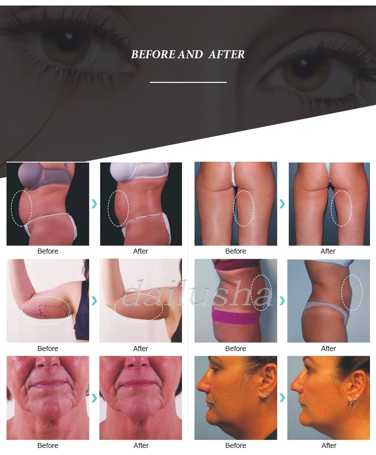 Lipolaser 40K кавитационная радиочастотная машина для похудения
