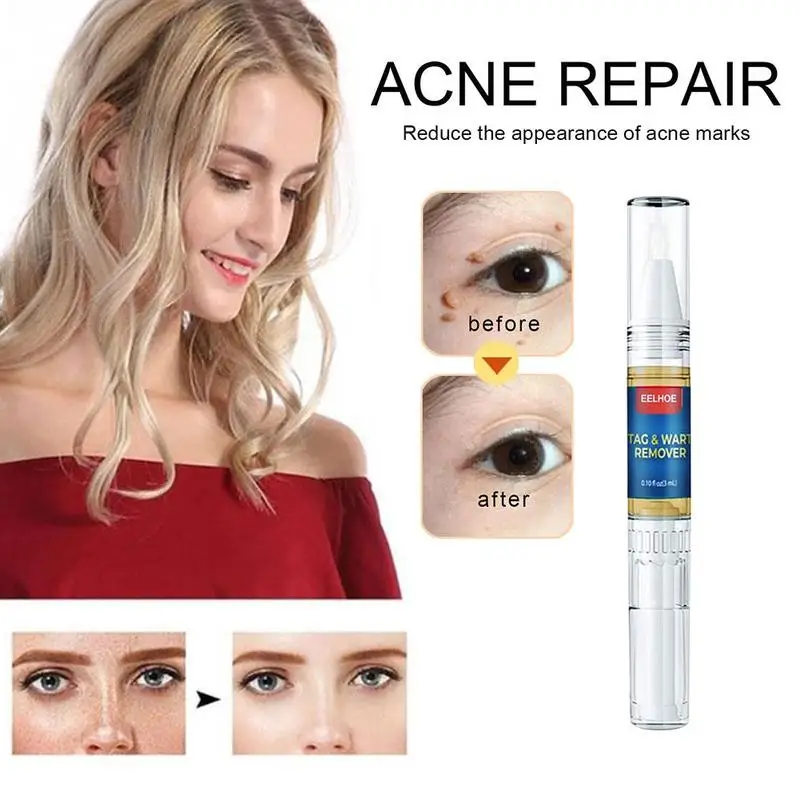 

Liquid Wart Removal Pen Genital Wart Treatment Fast Foot Care Wart Skin Removal Corn Tag Mole & Remover Skin Genital S2E9