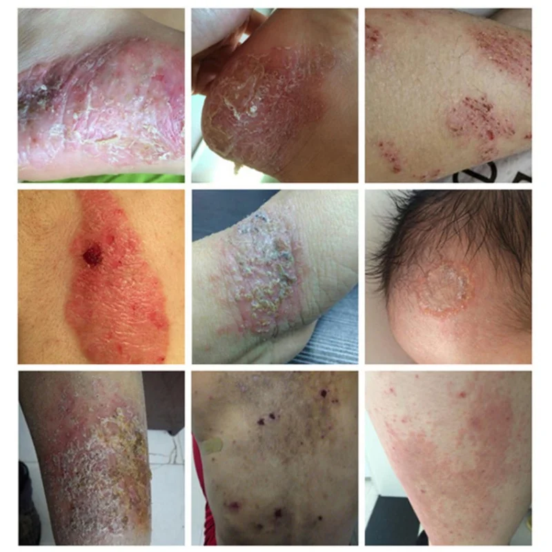 

Natural Herbal Skin Care Antipruritic Body Psoriasis Cream Dermatitis Eczema Pruritus Psoriasis Body Private Part Skin Cream