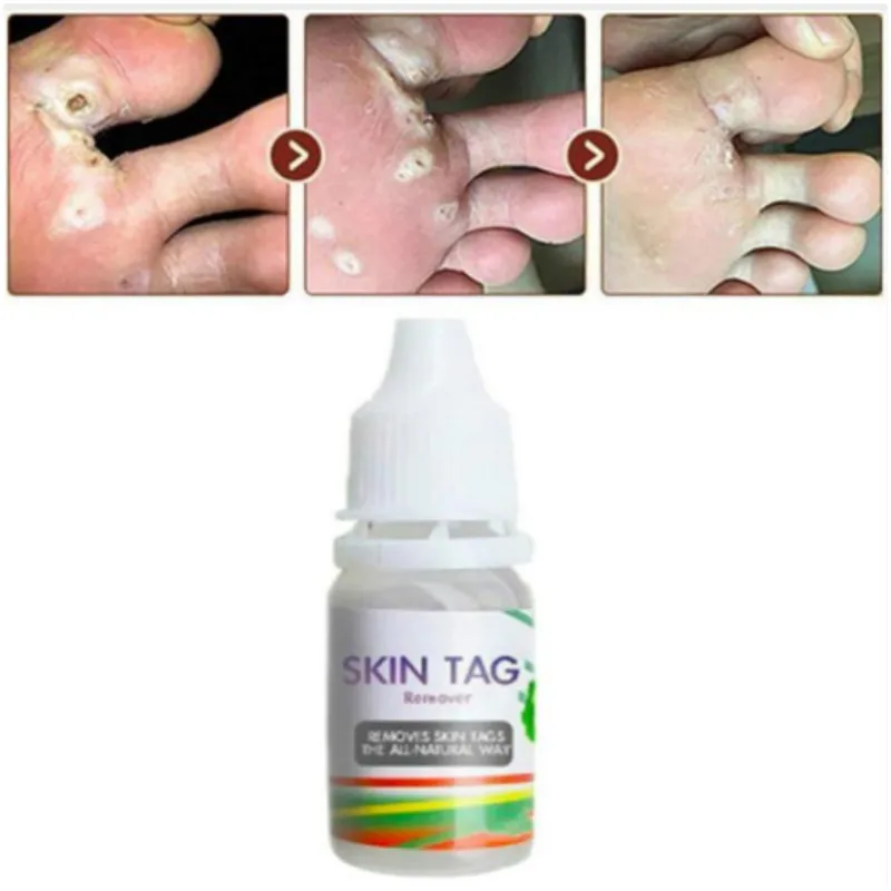 Горячая распродажа 10 мл крем для лечения бородавок средство удаления мозолей ног