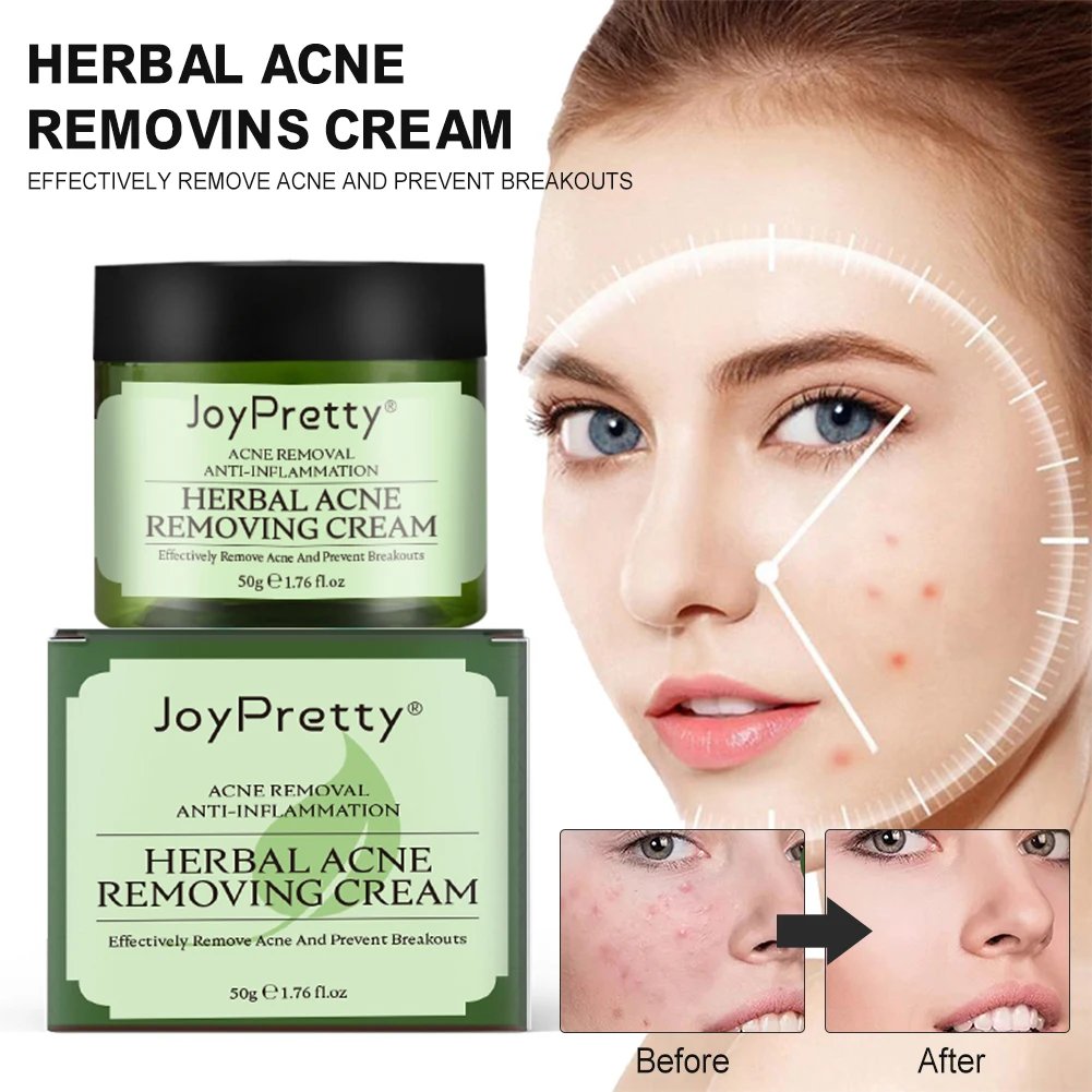 

New Product Herbal Tea Tree Blemishes Acne Marks And Acne Cream Anti-acne Natural Skin Cream Oil Control Cleansing Plant Cream