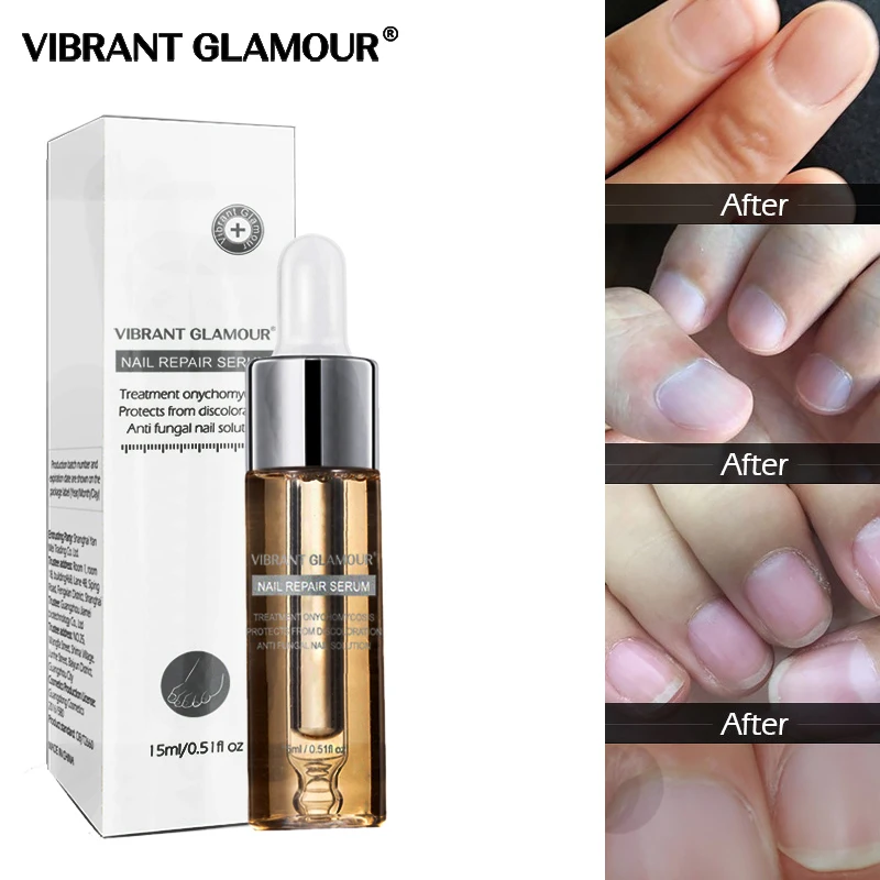 Средство для лечения ногтей от грибков эссенция ухода за ногами отбеливания на