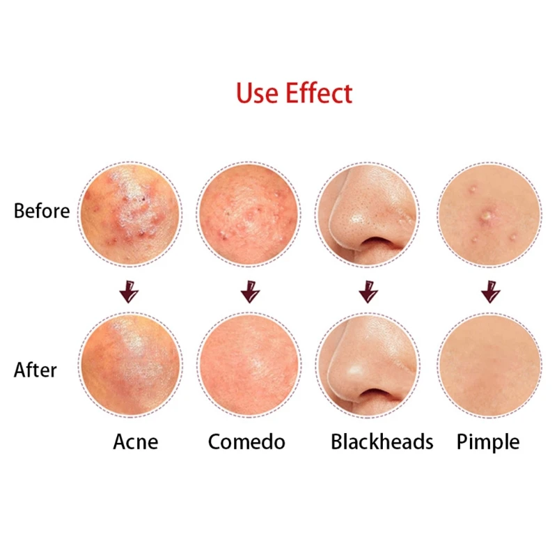 

4 pcs/Set Acne Blackhead Pimple Treatment Pin Kits Comedone Pin Needle Tool