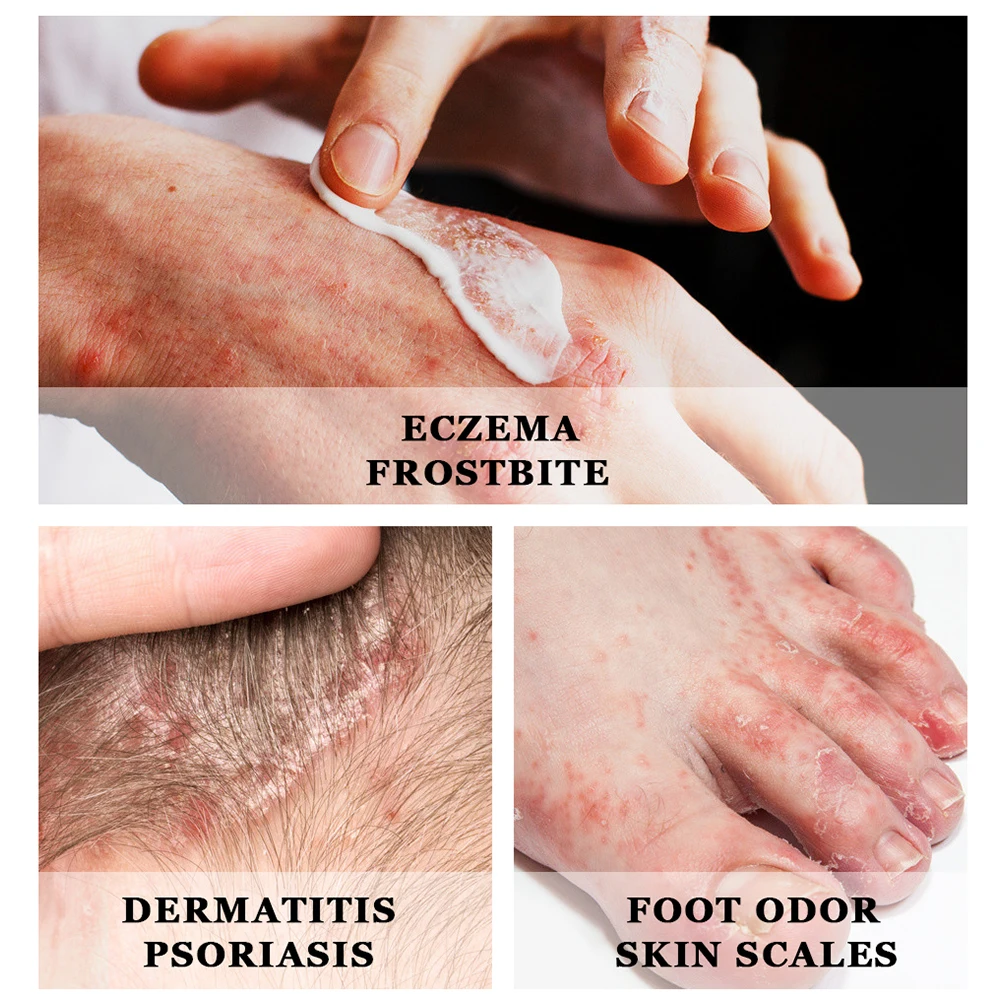 Антибактериальный крем от псориаза Yoxier лечение экземы крапивницы удаления зуда |