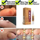 Средство для удаления бородавок, бородавок на ступнях, 5 мл