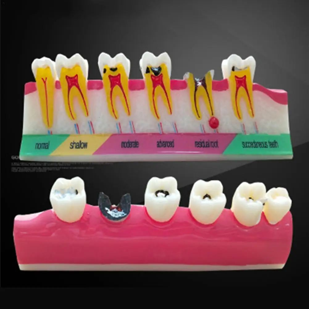 

Periodontal Disease Dental Teeth Model Display Periodontitis Show Teaching Tooth Model Dentist Communication