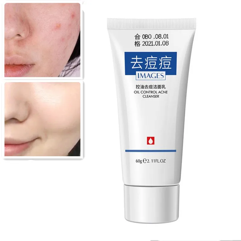 Горячая Распродажа для лечения прыщей очищающее средство лица устранения черных