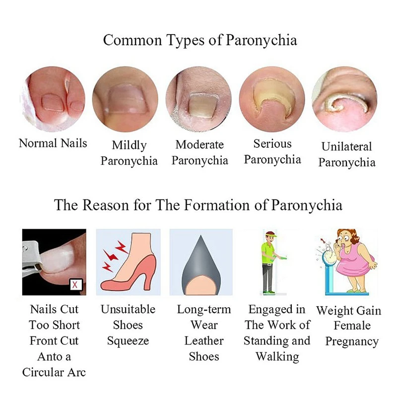 Вросший инструмент для педикюра на носках 10 шт./зажим выпрямления бутылок
