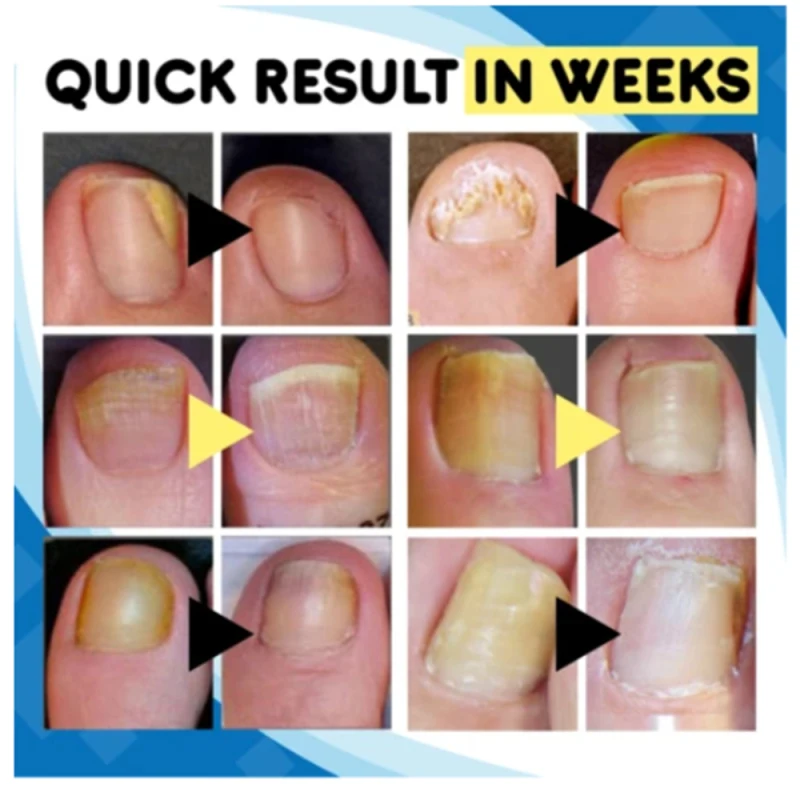 Лазерная указка Onychomycosis для безболезненного ремонта ногтей ручка | Красота и