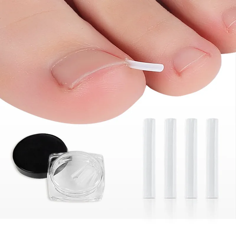 

10PCS Ingrown Pads Ingrown Toenail Pads Ingrown Nail Pads Ingrowing Nail Braces Ingrowing Nail Artifacts Orthopedic Foot Care