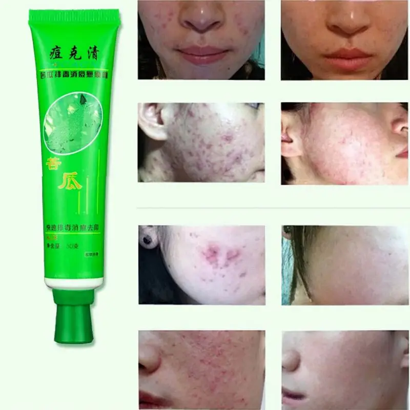 

Face Treatment Care Acne Scar Removal Cream Blemish Stretch Marks Moisturizing Whitening Women Beauty Health Anti-Acne Face Care