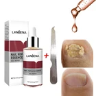 Эссенция для лечения грибка ногтей, гель для удаления грибка ногтей на ногах, защита от инфекций, паронихия, онихомикоз, уход за ногтями на пальцах ног, восстанавливающая сыворотка