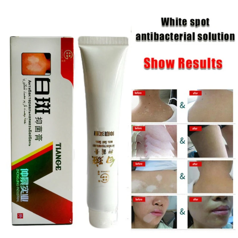 

Chinese Medical White Spot Disease Cream Pigment Melanin Promoting Liniment Skin Vitiligo Leukoplakia Disease Treatment 30g