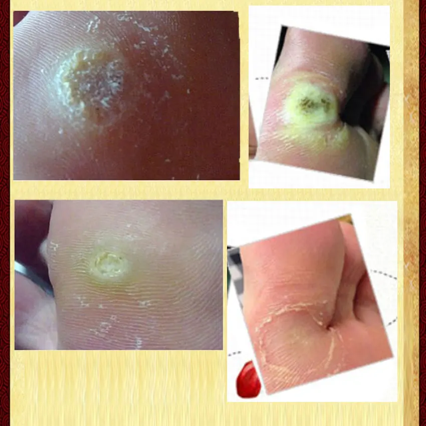 Chinese Medicine Treatment Foot Corn Removal Plantar Warts Pomada De Verruga Care Medical Plaster Ointment | Красота и здоровье