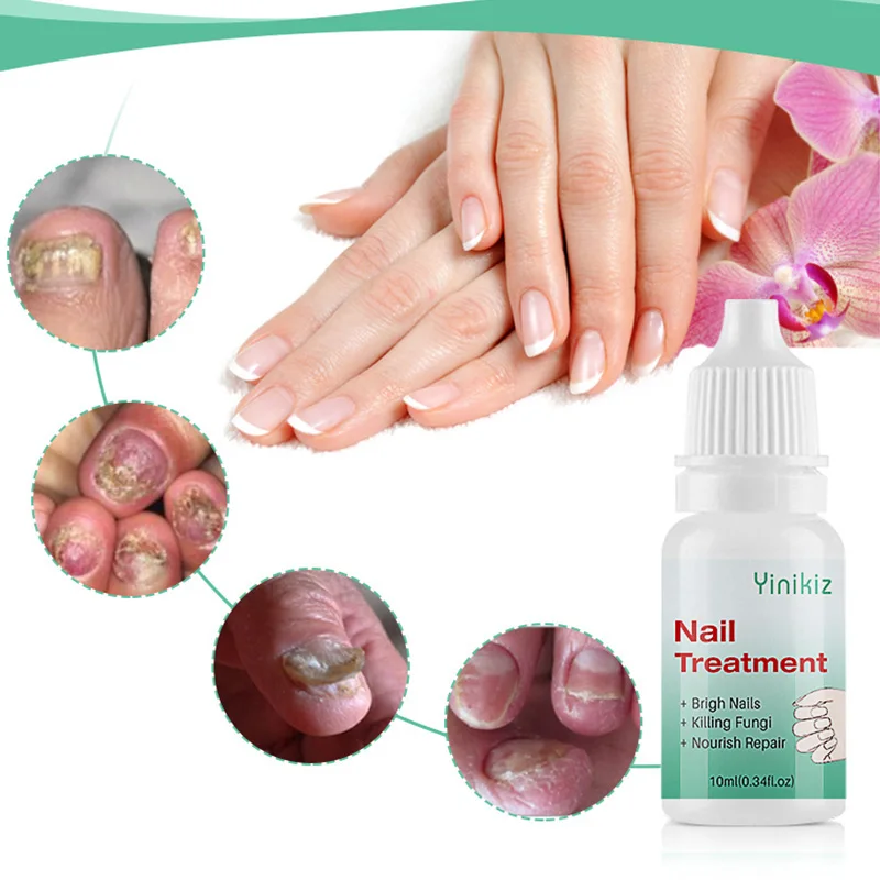 Лечение трав грибка для ногтей Удаление ног гель ухода за ногами эссенция