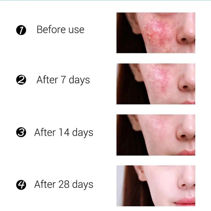 

Effective Acne Removal Cream Acne Treatment Fade Spots Oil Control Shrink Pores Whitening Moisturizing Acne Essence Skin Care