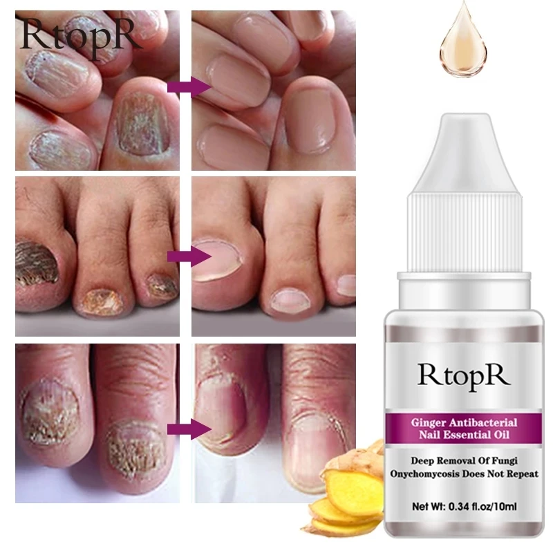 

RtopR Nail Fungal Treatment Anti Bacterial Infection Toe Essence Removal Paronychia Onychomycosis Gel Foot Repair Nail fluid 10g