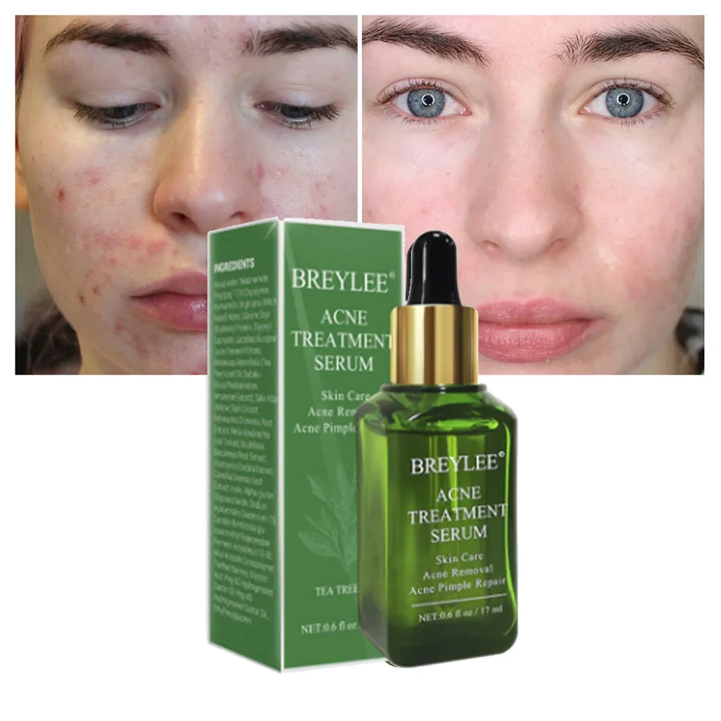 Effective Face Skin Care Essence Acne Spots Scar Removal Blemish Marks Treatment Shrink Pores Moisturizing Dropshipping ZJXT2 | Красота и