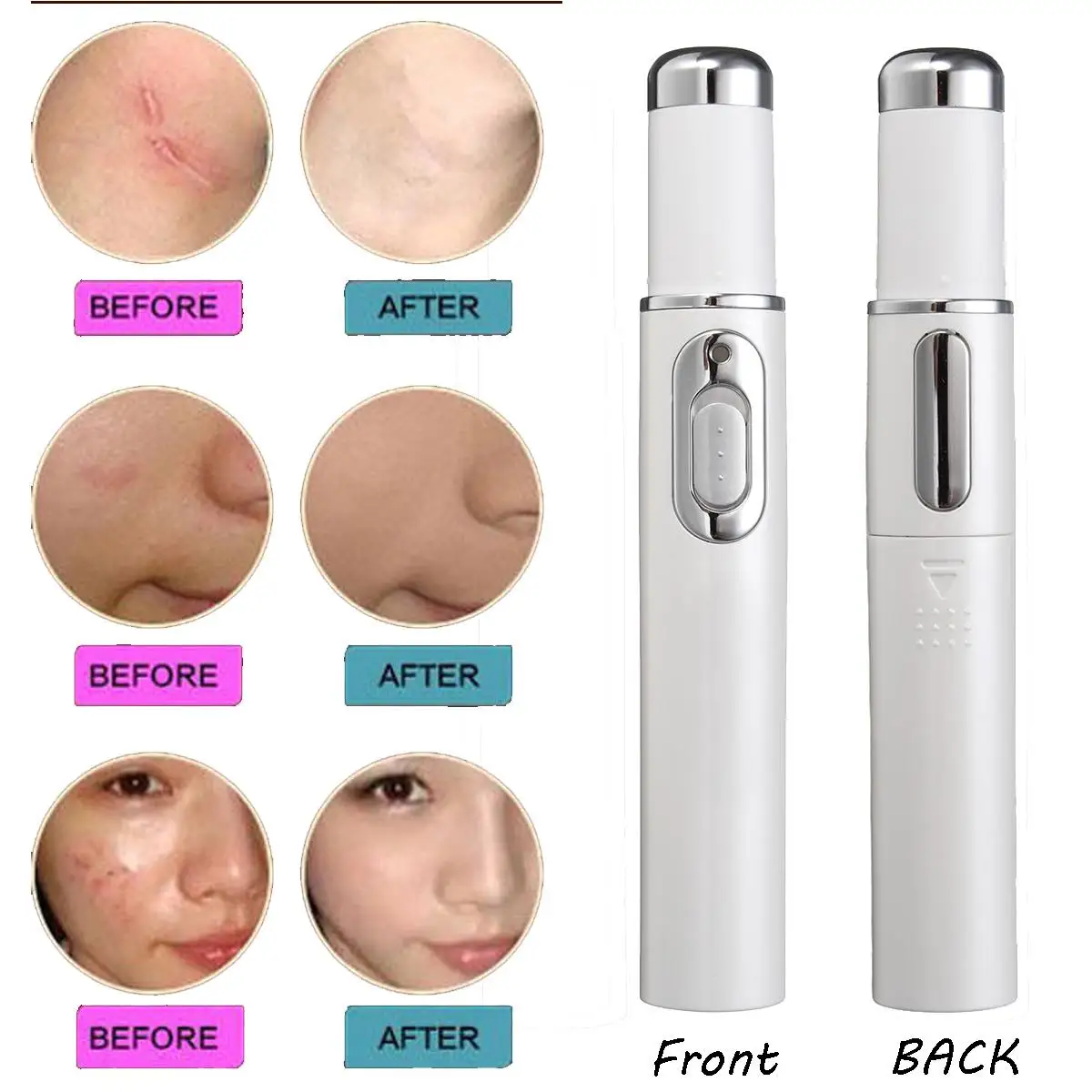 

1Pc Women Blue Light Therapy Acne Laser Pen Soft Scar Removal Tightening Pores Shrinking Anti-wrinkle Beauty Facial Skin Care