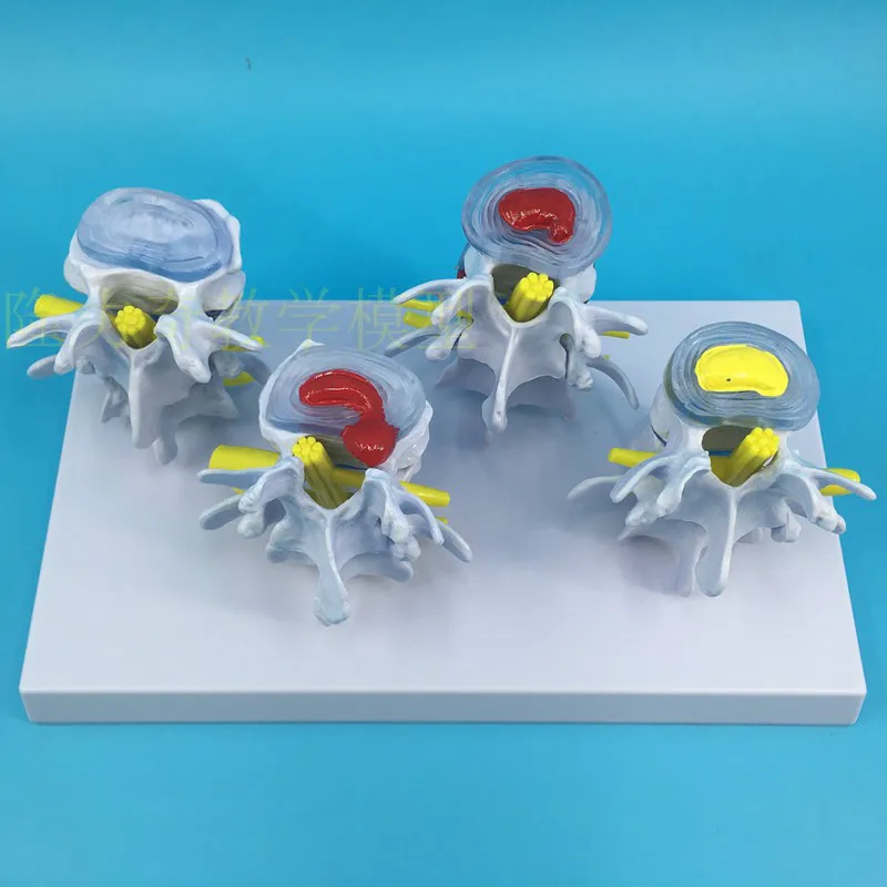 

Four stage lumbar model Bone pathological model Spine Disc herniation and deformation