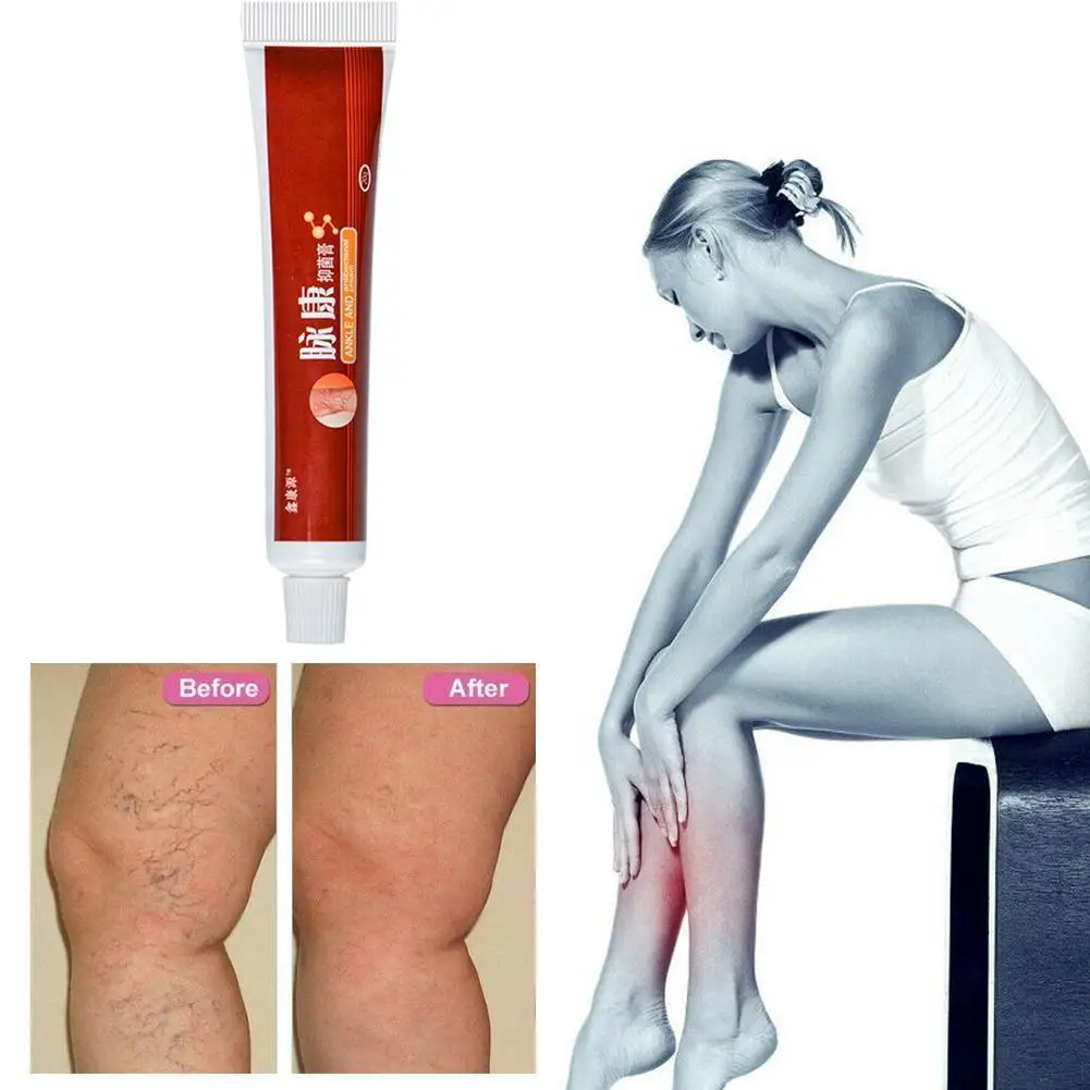 

1pcs Varicose Veins Treatment Cream Varicosity Angiitis Relief Health Ointment Pain legs Phlebitis Veins Care Remedy V3B2