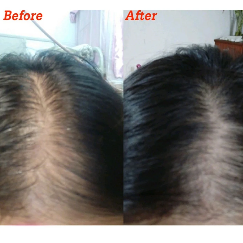 20 мл роста волос Сыворотки дермы кожи головы интенсивной ампулы тройной рулон