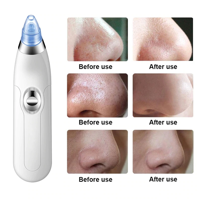 Очиститель пор средство для удаления черных точек глубоких Удаление прыщей