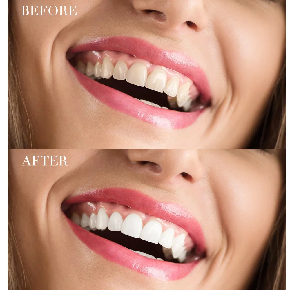 Комплект для отбеливания зубов пероксидная система комплект геля полости рта