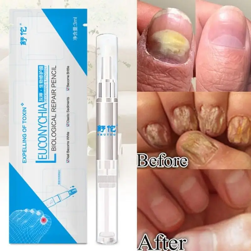Противогрибковые ручки для лечения Ногтей Onychomycosis Paronychia инфекция травяной носок ногти лечение здоровья Красота аксессуары