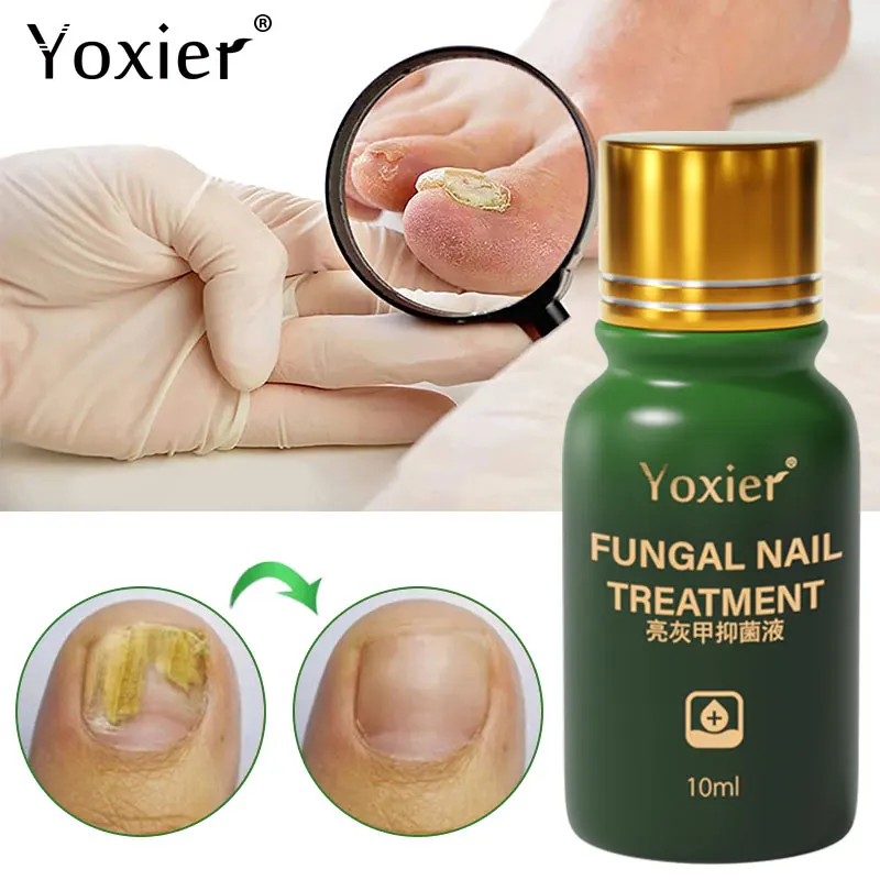 Сыворотка для лечения грибка ногтей эссенция восстановления паронихия