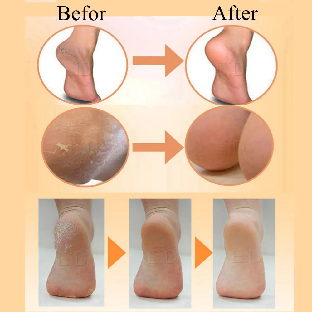 Подошвенный фасциит носки для ачиллового тендонита мозолей трещин боли