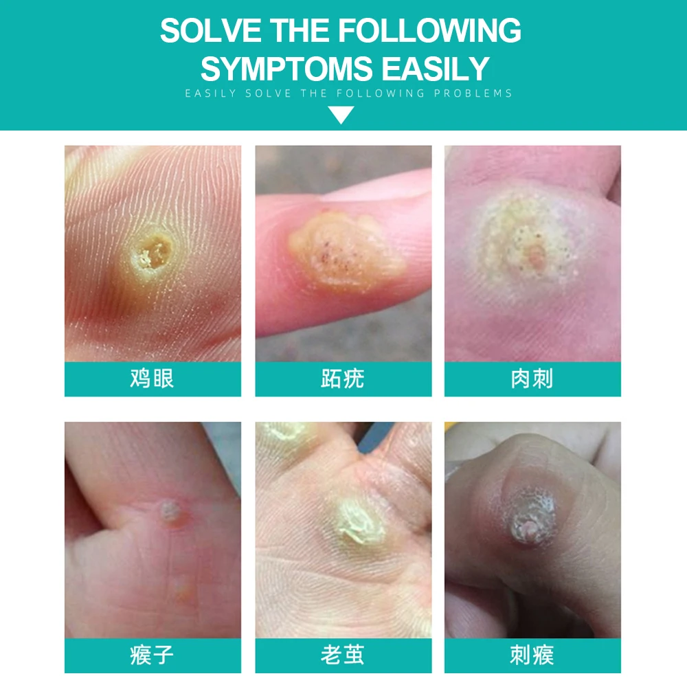 Cofoe 6 шт./компл. медицинские пластыри для ухода за ногами куриных глаз удаления