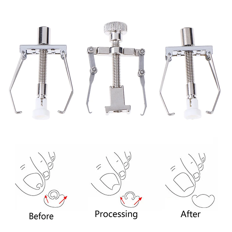 Инструмент для коррекции вросших ногтей инструмент набор инструментов педикюра