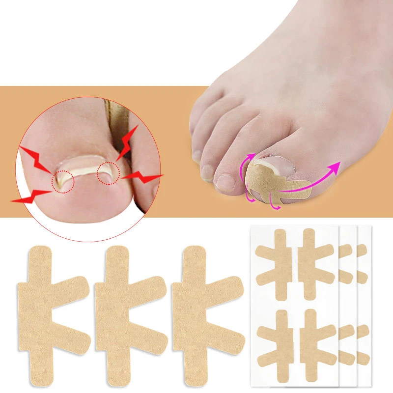 1 набор корректор для вросших ног|Инструмент ухода за ступнями| |