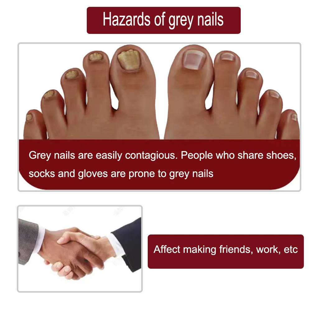 Грибковая Сыворотка для ногтей эссенция противоинфекции боронихия средство