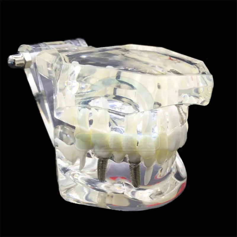 Модель зубная прозрачная для восстановления зубов модель внедрения заболеваний