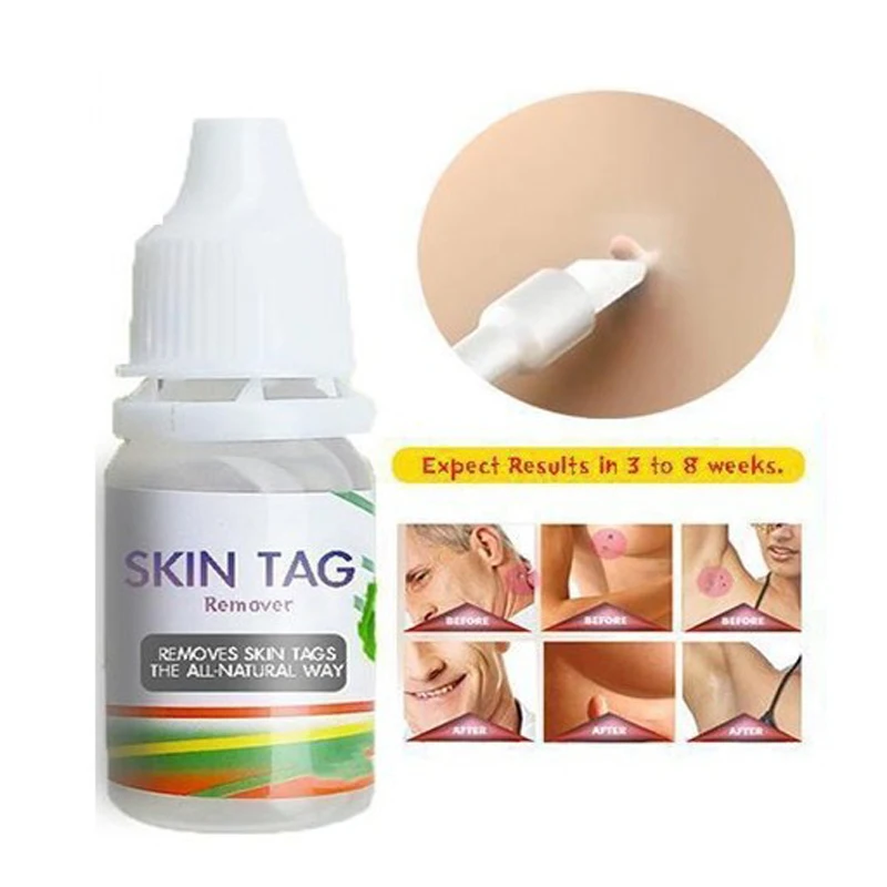 Средство для удаления родинок и гениталий на коже 10 мл|Сыворотка| |