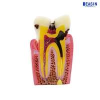 high quality new denture teeth model 6x caries comparison model tooth decay modeldentist for medical science teaching